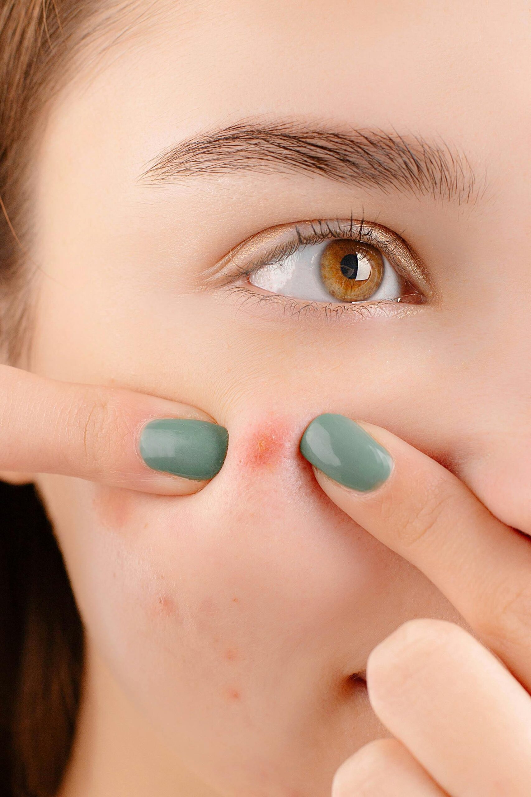 A young woman squeezing a pimple on her face, showing skin irritation and acne details in a studio setting.
